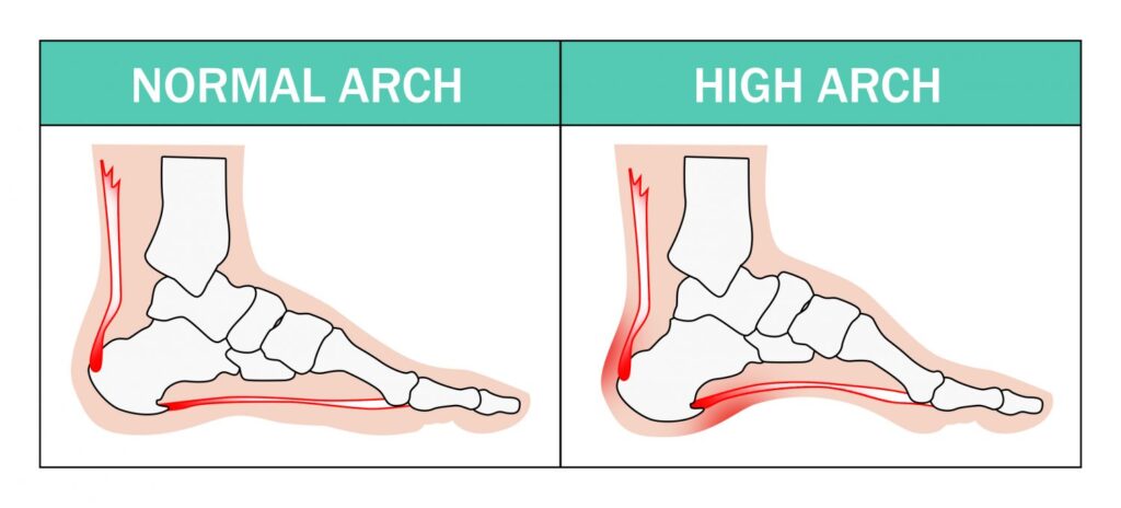 The Ultimate Guide to High Arch High Instep Foot Conditions