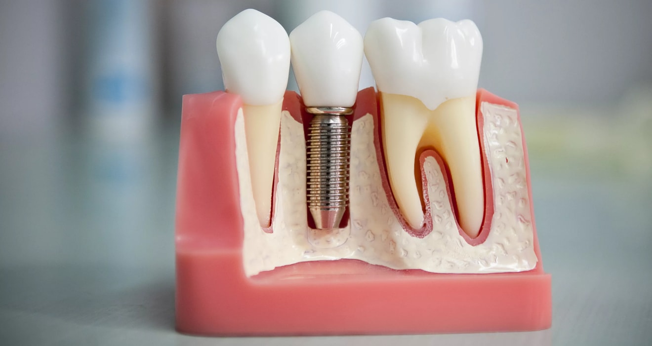 Dental implants Leichhardt